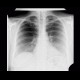 Lobus venae azygos, azygous vein lobe: X-ray - Plain radiograph